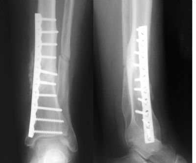 Tibia, Shaft:  Synthes DCP (Implant 294)